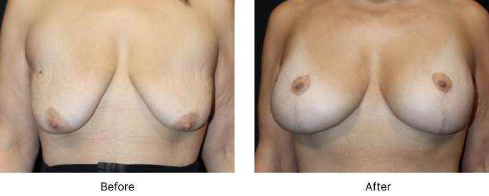 Breast Lift Before and After Las Vegas