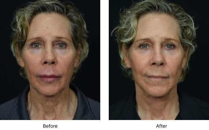 Facelift Before and After Las Vegas