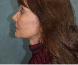 Neck Lift Before and After Las Vegas