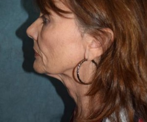 Neck Lift Before and After Las Vegas